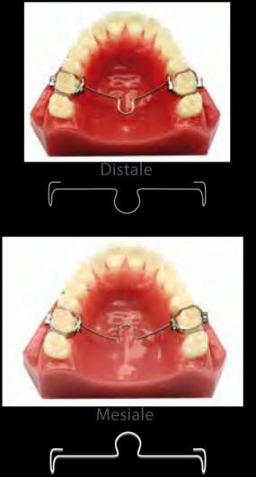 تقويم  بالتال بار  PALATAL BAR